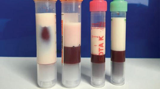 血脂高于多少为重度高血脂,血脂达到多少容易得血栓