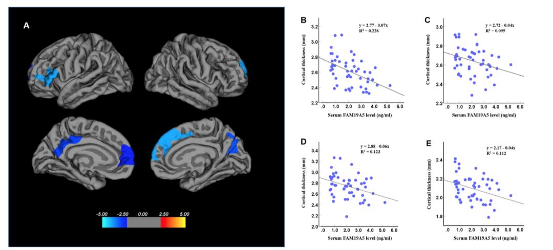 抑郁生物标志物,重度抑郁症患者神经元