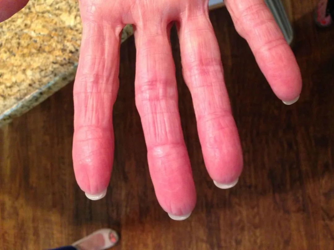 没有指纹的人的命运,天生无指纹的人多吗