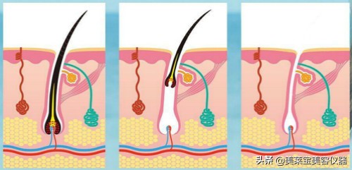 激光脱毛和冰点脱毛哪个好知乎,激光脱毛和冰点脱毛哪个好