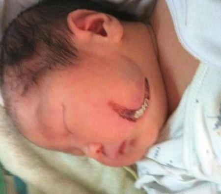 产钳助产会吓到宝宝吗,产钳助产对小孩有什么影响吗