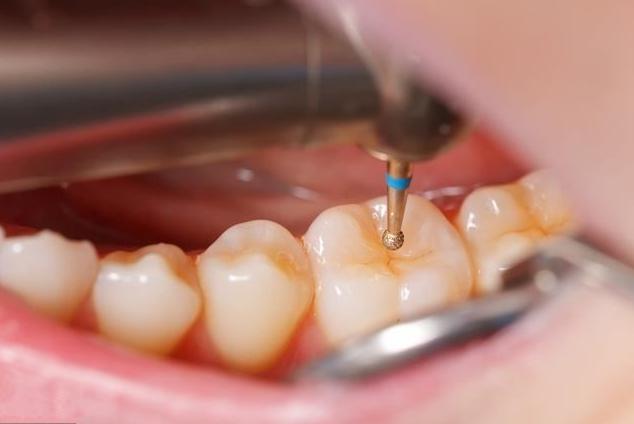 牙齿缺损的修复材料,牙齿龋坏补牙用什么材料