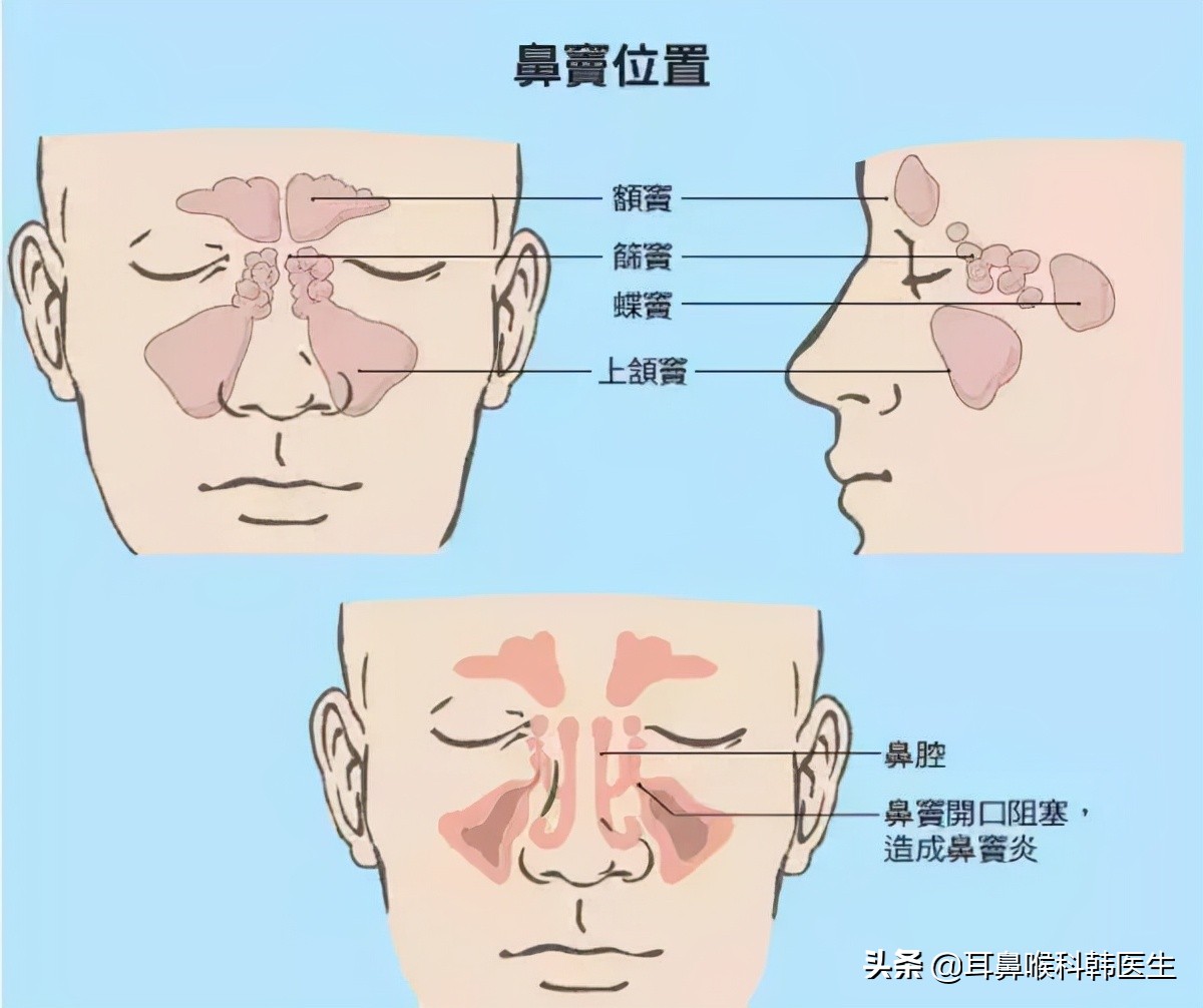 鼻炎鼻窦炎有什么区别科普,为什么鼻腔炎症易引起鼻窦炎