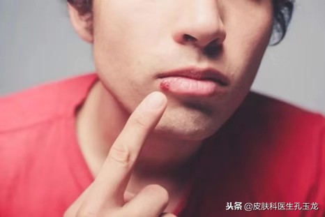 皮肤科常见疾病:嘴唇上火的真相——单纯疱疹