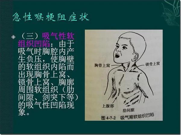 孩子突然喉咙哑了,喉咙突然哑了但是不痛不痒
