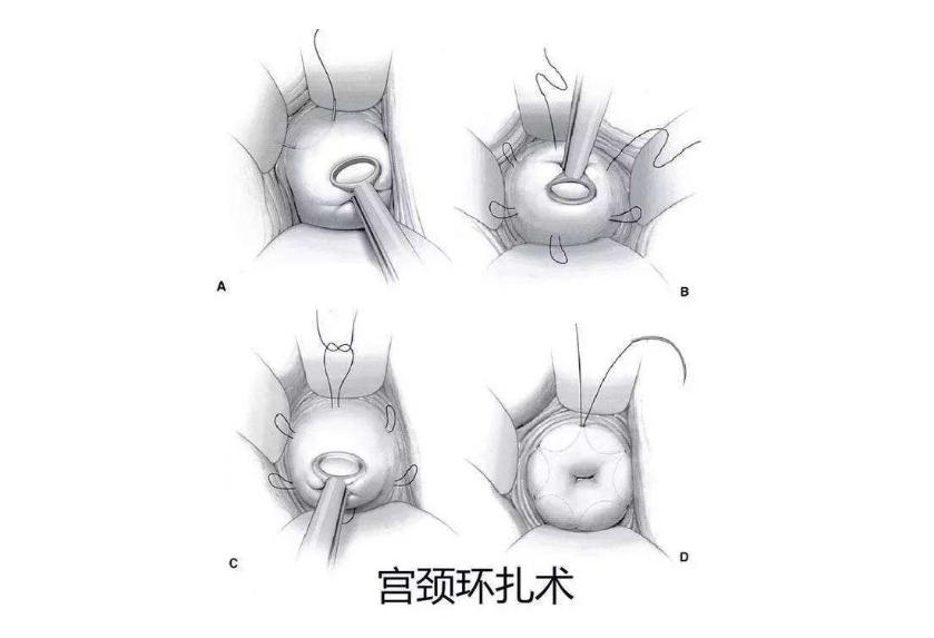 世上最难的职业——孩子妈，31岁妈妈怀孕5次终得女