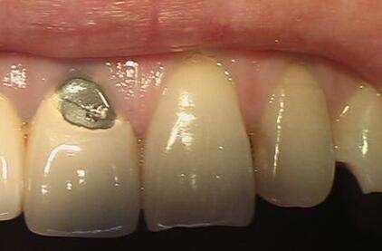 烤瓷牙崩了一块修复方法,烤瓷牙崩瓷了怎么修复