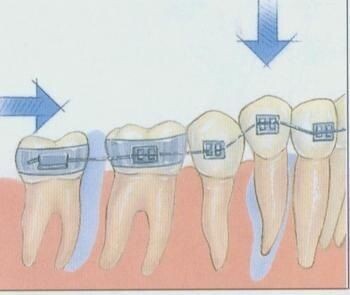 刚刚做完牙齿矫正需要注意什么,牙齿矫正结束后的注意事项