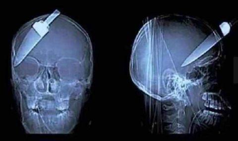 不作死就不会死,看看这些被人类搞进身体里的异物