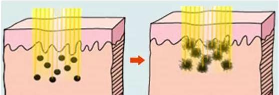 脸上长了一块灰褐色的斑,脸上有大块灰斑怎么办