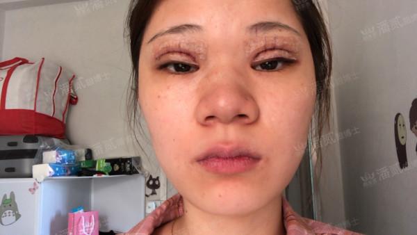 什么样的肿眼泡适合全切,什么样的肿眼泡不用动提肌