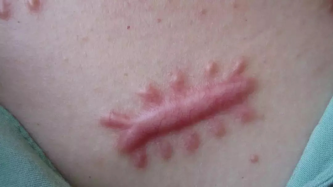 受伤了怎么处理最有效,受了伤留了疤如何去