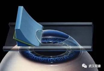 近视眼手术的发展史动画,近视眼手术发展史图片