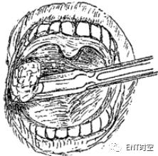「慢性扁桃体炎」必须要知道的七大要点