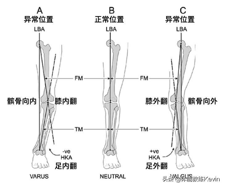 小儿足外翻康复训练弹力绷带,儿童足外翻康复训练教程