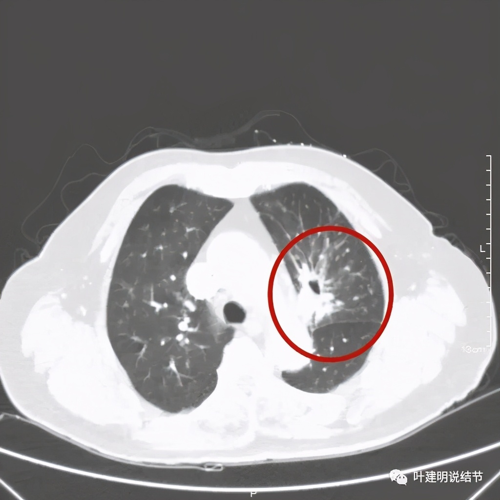 卡瑞利珠单抗治疗肺鳞癌有用吗,特瑞普利单抗对鳞癌治疗有效吗