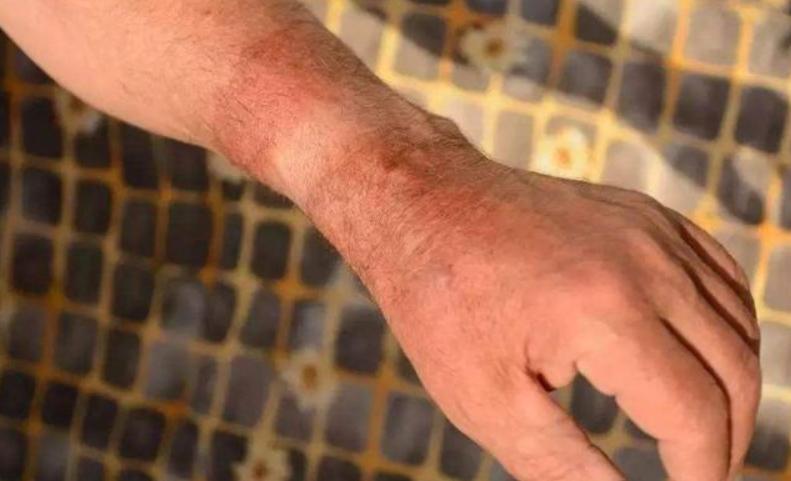 孩子被烫伤后，要先冲水还是先脱衣服？第一步做错，会加重伤情