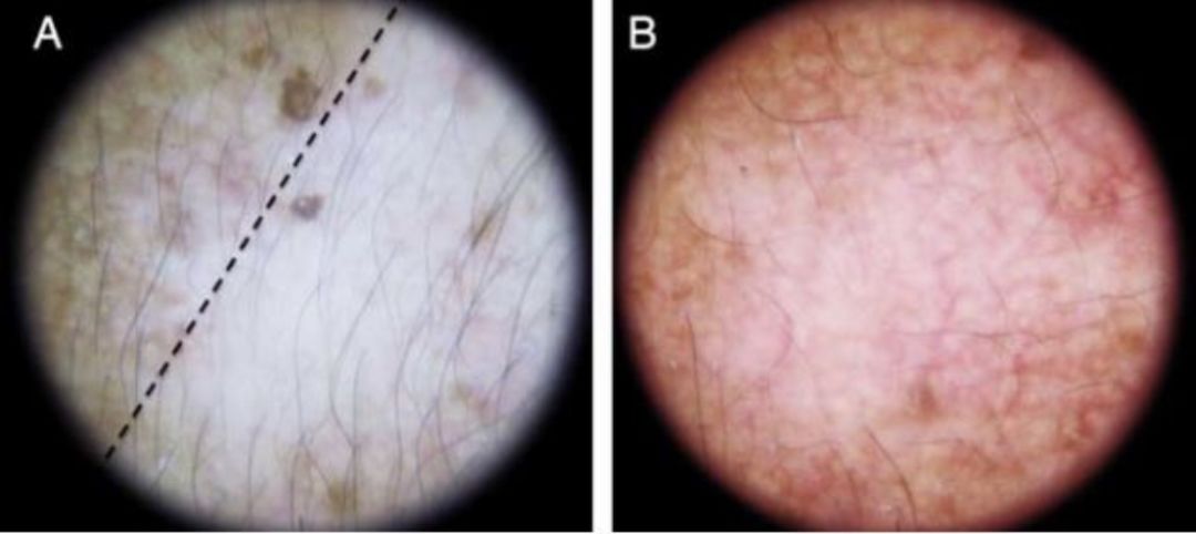 褐青斑与黄褐斑鉴别,面色容易出现褐斑