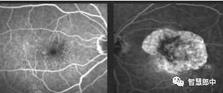 年龄相关性黄斑变性辅助检查,年龄相关性黄斑变性