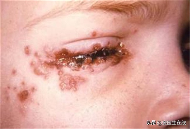 单纯疱疹到底是啥？对孩子身体有什么影响？家长不妨了解一下