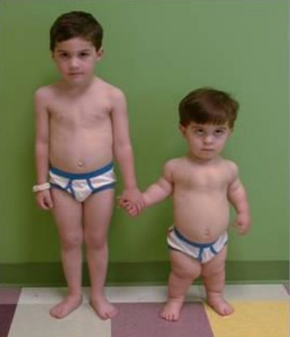 软骨发育不全综合征手术,先天性软骨发育不全矫正