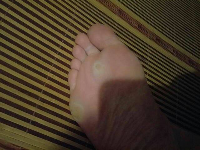 去除脚上老茧老皮的小妙方,脚上老皮老茧去除小妙方