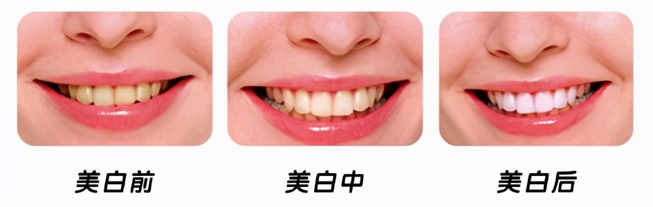 皓齿美白的真实感受,皓齿美白后酸痛严重