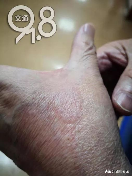 男孩被化学药水弄瞎眼睛,男孩被化学药水弄了眼睛