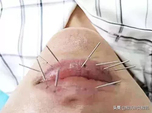 怎么治痘痘痘印最有效的方法,如何治好痘痘痘印最有效