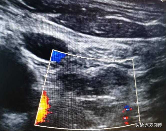 甲状腺癌手术后转移淋巴后果,甲状腺癌术后转移几率大吗