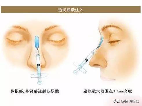 隆鼻失败修复的几点建议,隆鼻失败医生会马上为患者修复吗