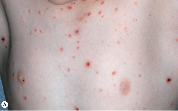 过敏性紫癜算是风湿病的一种吗,风湿性关节炎与过敏性紫癜区别