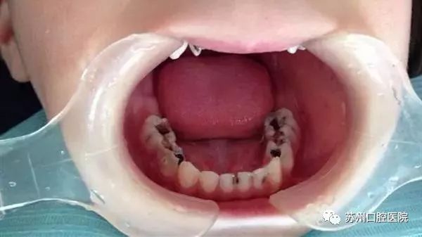 乳牙蛀牙清除真实全过程,小儿乳牙龋齿民间治疗偏方