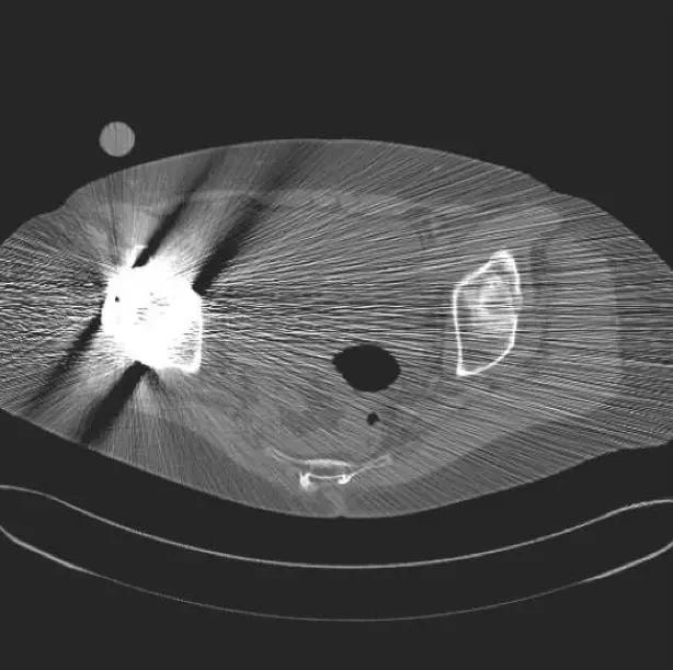 ct图像解析大全,ct图像与实物大小对比