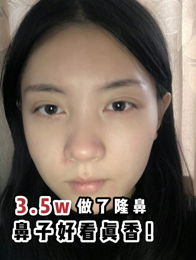 鼻子很高很挺的隆鼻案例,3万元左右的隆鼻效果图