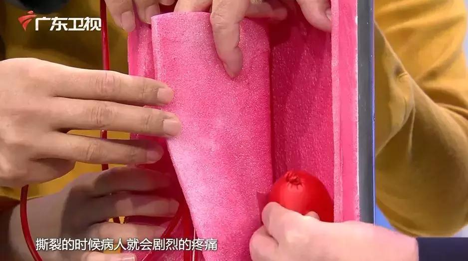 主动脉夹层手术后会猝死吗,主动脉夹层破裂猝死有救吗