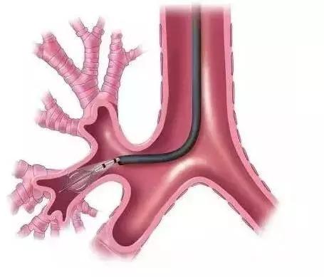 体检发现“肺小结节”怎么办？胸外科医生来谈一谈