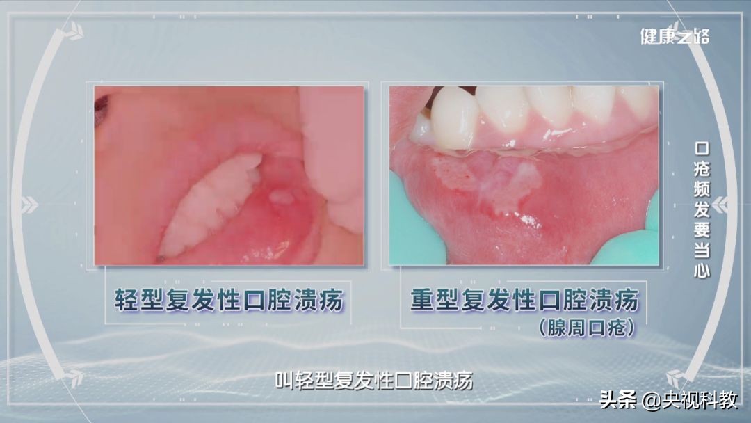 口腔溃疡生疮最快解决方法,长时间口腔溃疡的最快解决办法