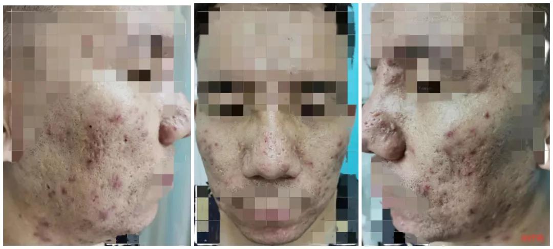 治痘疮最好的办法,战痘的最佳治疗方案