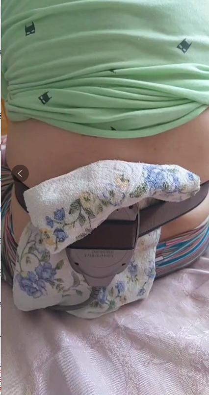 腰突恢复到什么程度才算康复,腰突怎么彻底治愈