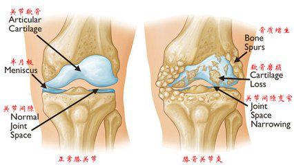 干细胞彻底治关节炎吗,干细胞真的能够治疗骨关节炎吗