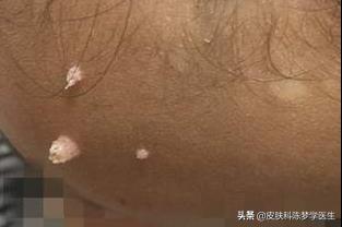 脖子上长了几个针尖大的肉球,脖子上长了丝状疣是感染了hpv吗