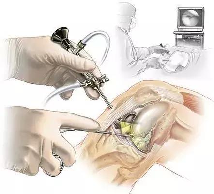 膝关节问题讲解,关于关节炎的问题