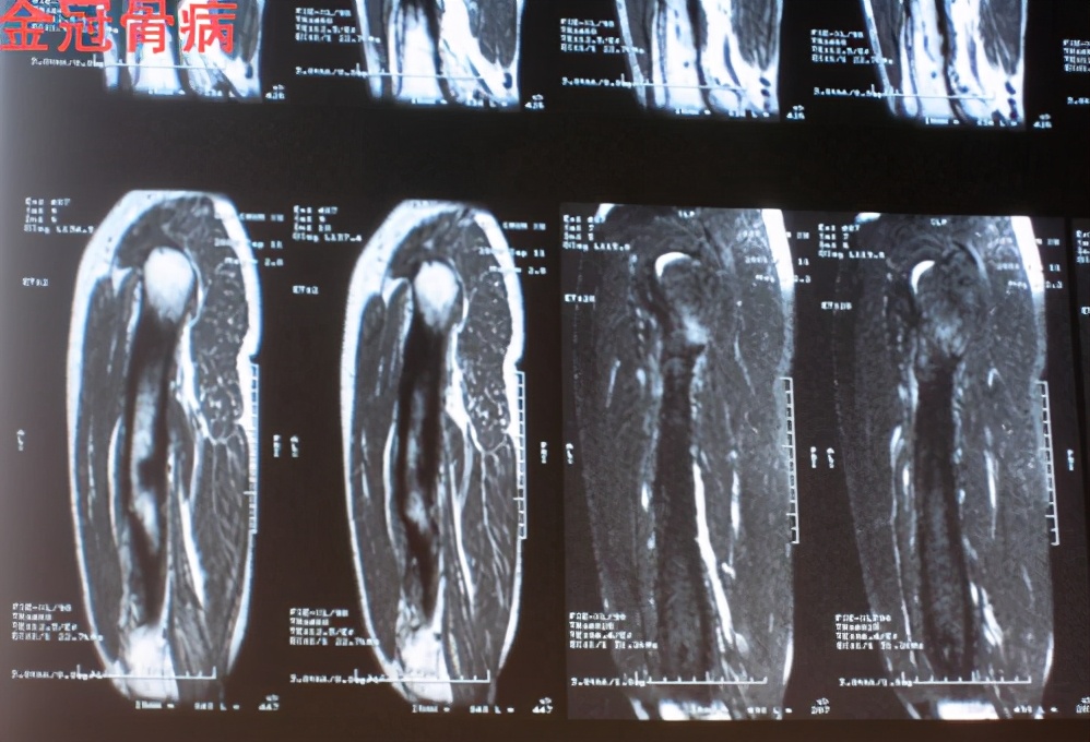 硬化性骨髓炎的临床症状,硬化性骨髓炎会遗传吗