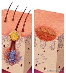 毛囊炎是不是小毛病,皮肤毛囊炎的原因和治疗方法