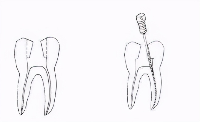 根管治疗器械有哪几种,根管治疗器械大全