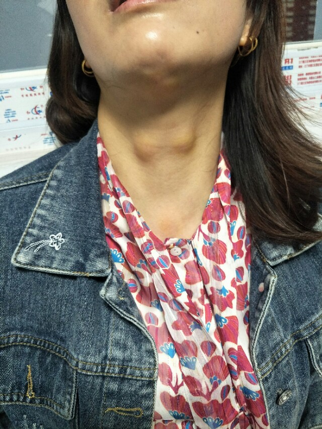 穴位注射治疗慢性咽喉炎图片,治疗咽喉炎扎针有效果吗