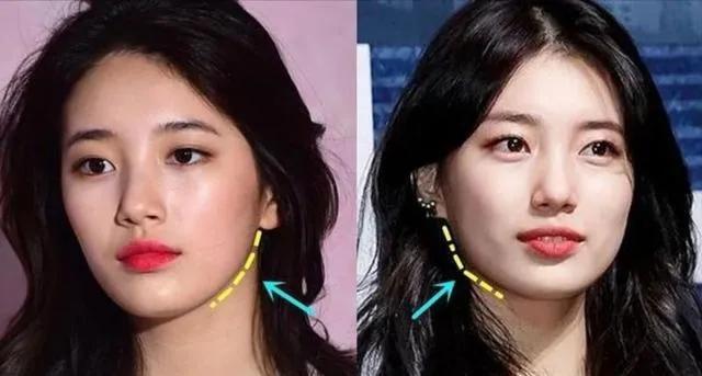 刘亦菲发腮什么意思,发腮的原因找到了