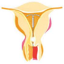 上了曼月乐环不来月经怎么回事,曼月乐环有什么作用