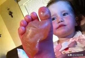 孩子烫伤的紧急处理四大步骤,孩子烫伤“五步”急救法